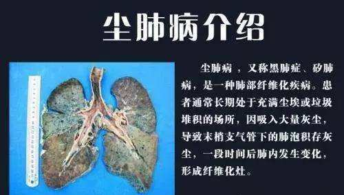 【pg电子官网官方网站】好消息！开州有属于自己的尘肺病肺康复站(图1)
