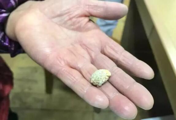 大妈一阵咳嗽,竟吐出一块石头!医生却说她好幸运!