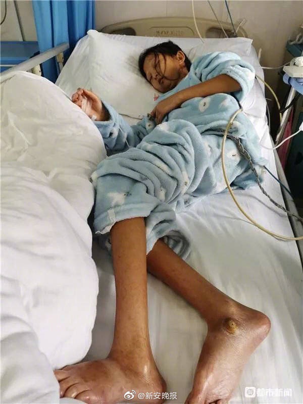 24岁仅43斤女学生获捐47万花3天写信致谢重见太阳