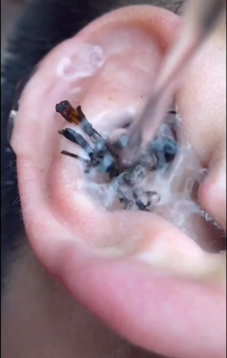 现在采耳也太奇葩了!在耳朵上放茶叶,直接往里面倒水,这操作真看不懂